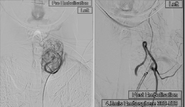 Image of Thyroid Embolization