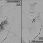 Image of thyroid embolization