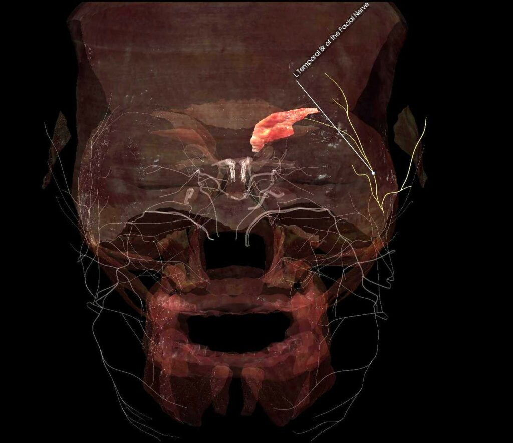 3D rendering of a facial muscle in the eyebrow region