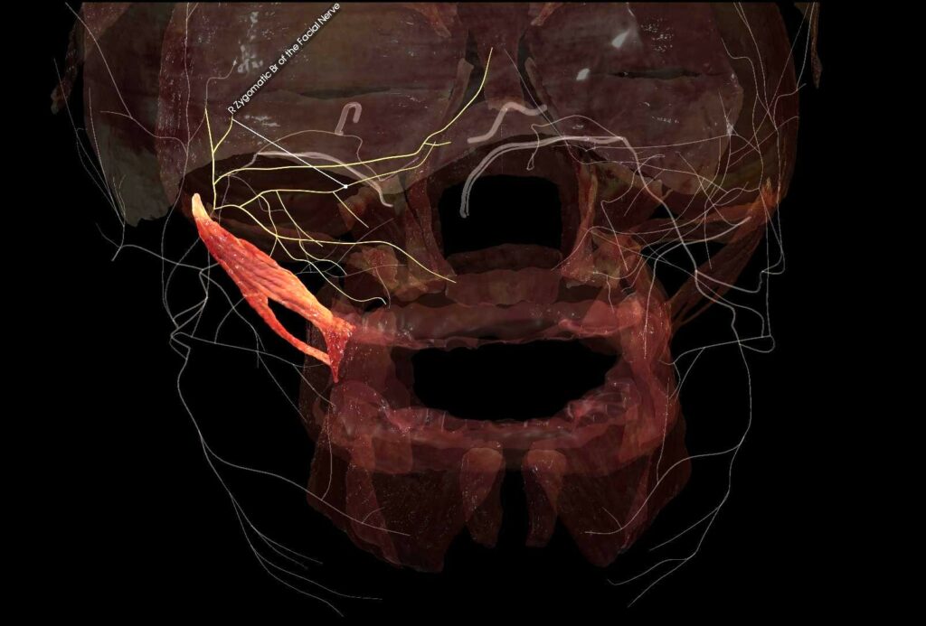 3D rendering of a facial muscle in the cheek region